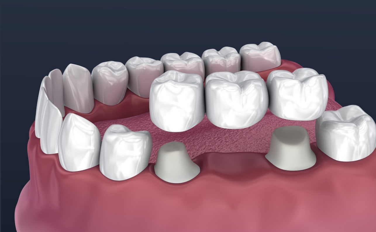 dental bridges in sherwood park