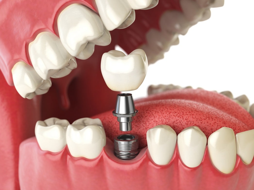 dental implants near you