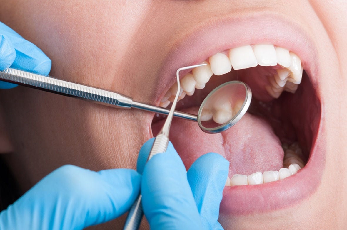 simple dental extractions in sherwood park