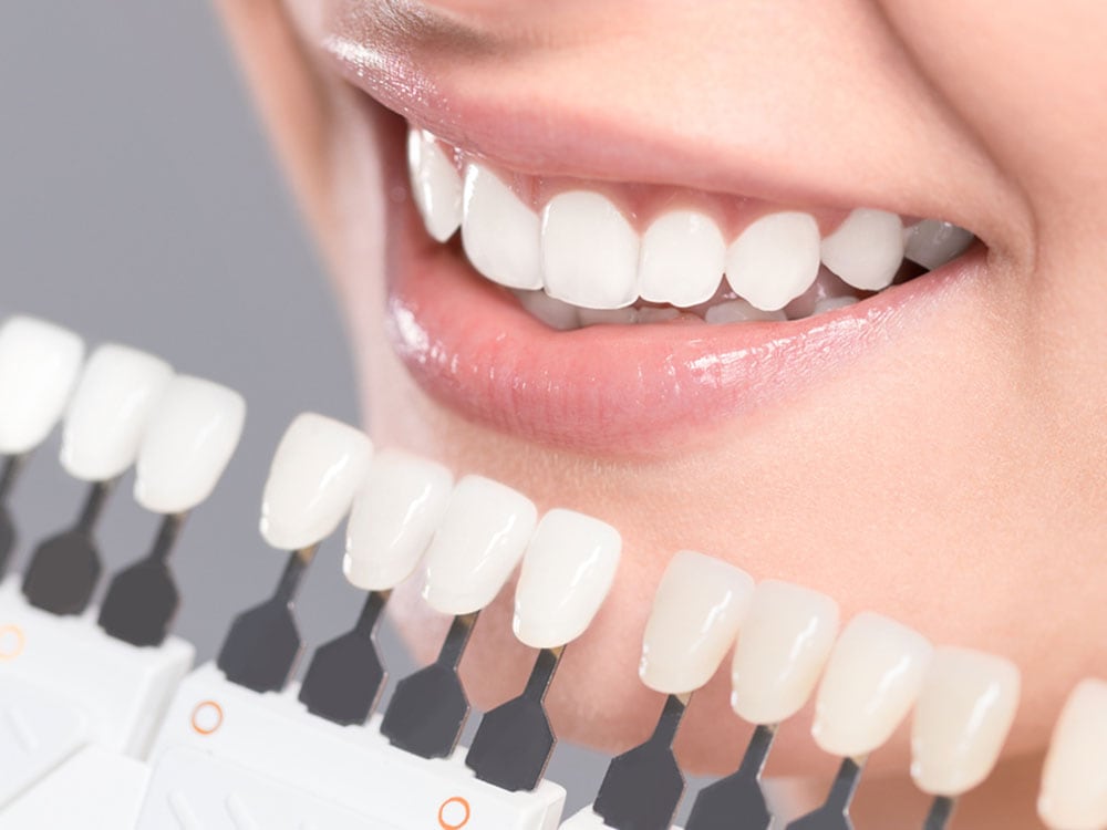 teeth whitening in sherwood park