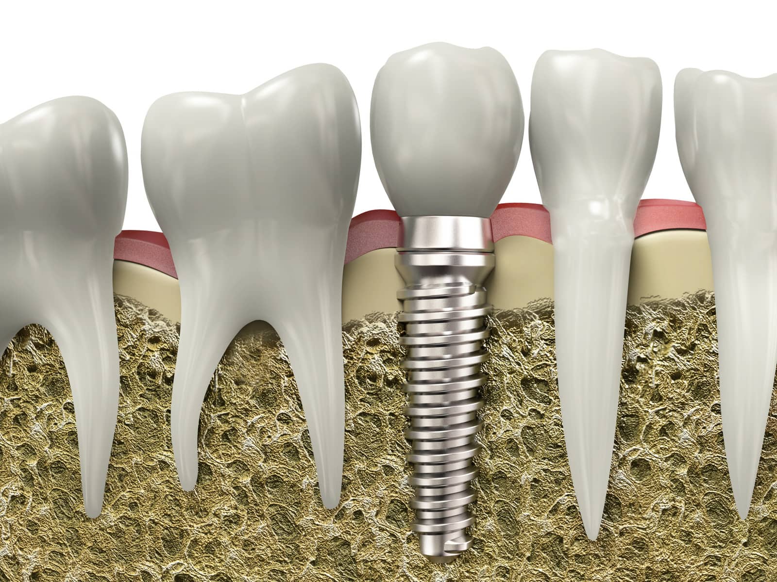 can you replace all your teeth with implants