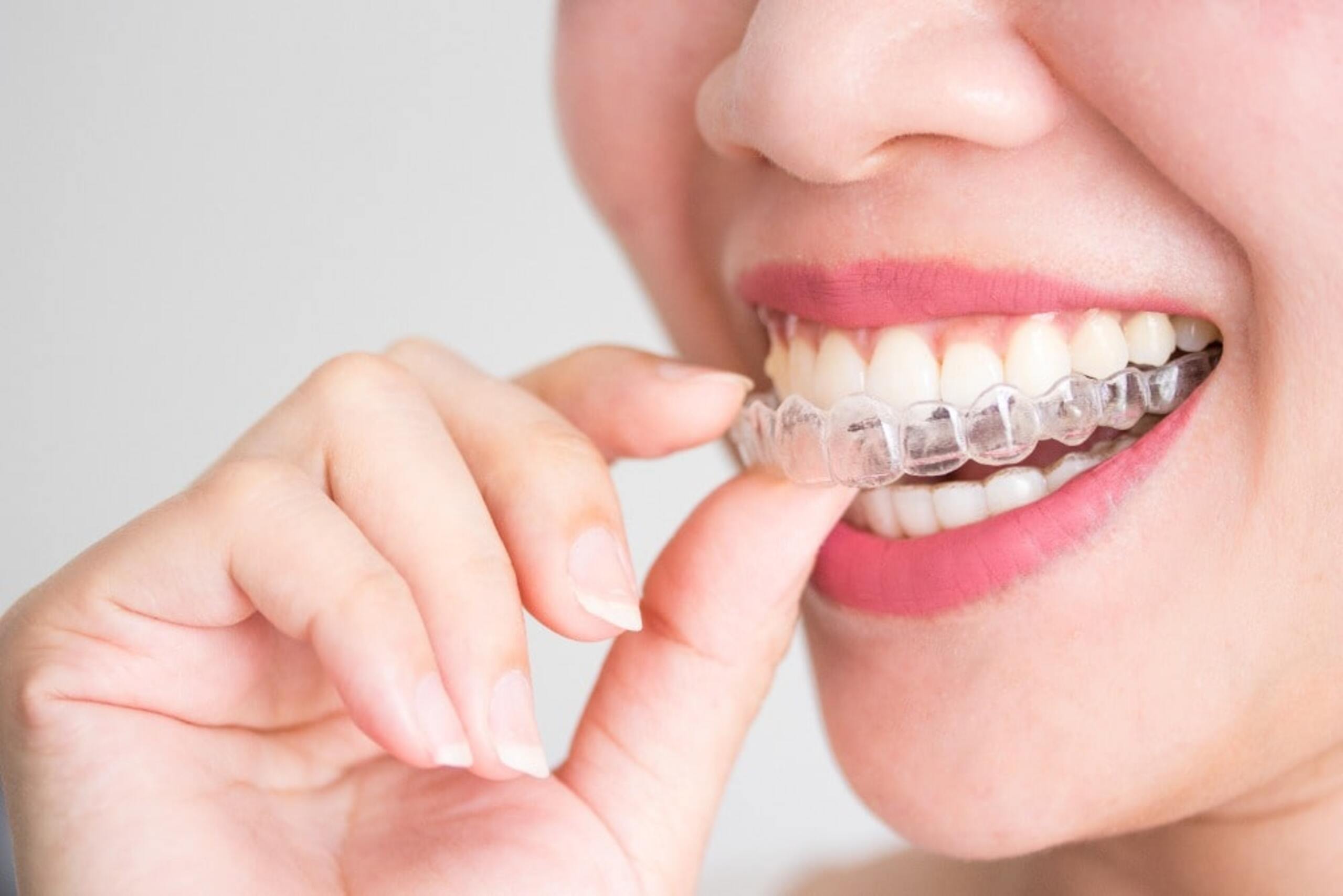 five tips for getting the best results with invisalign