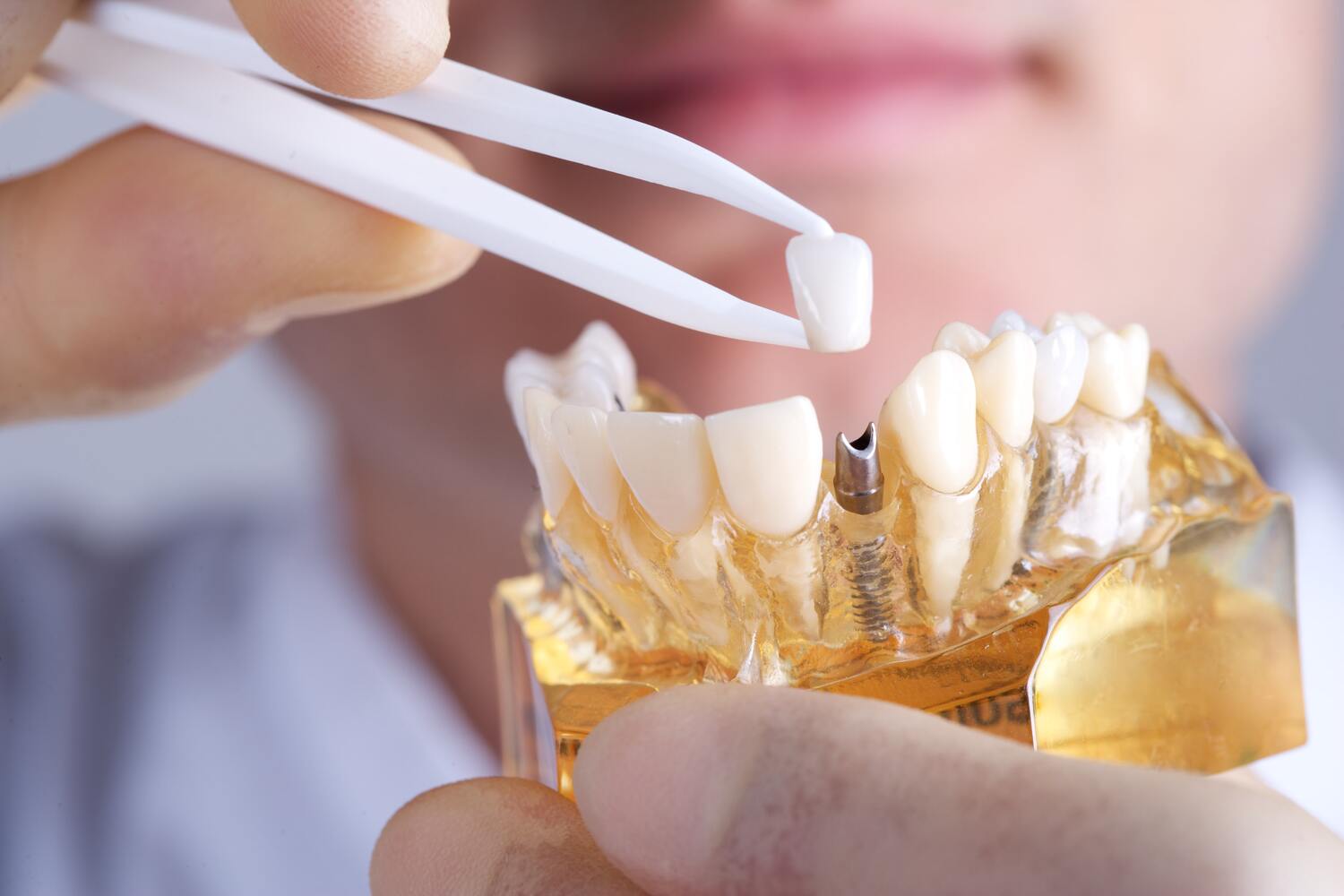 heres why to consider dental implants