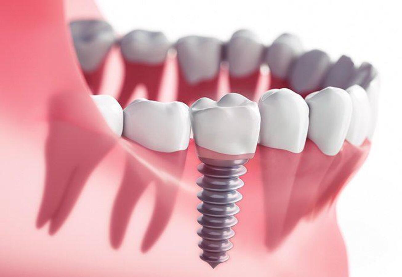 how to regain your confidence with dental implants