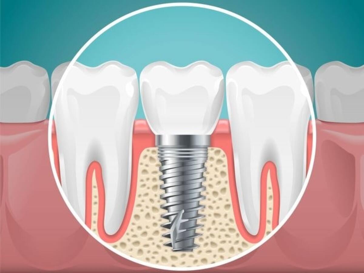 dental implants a great solution for replacing missing teeth