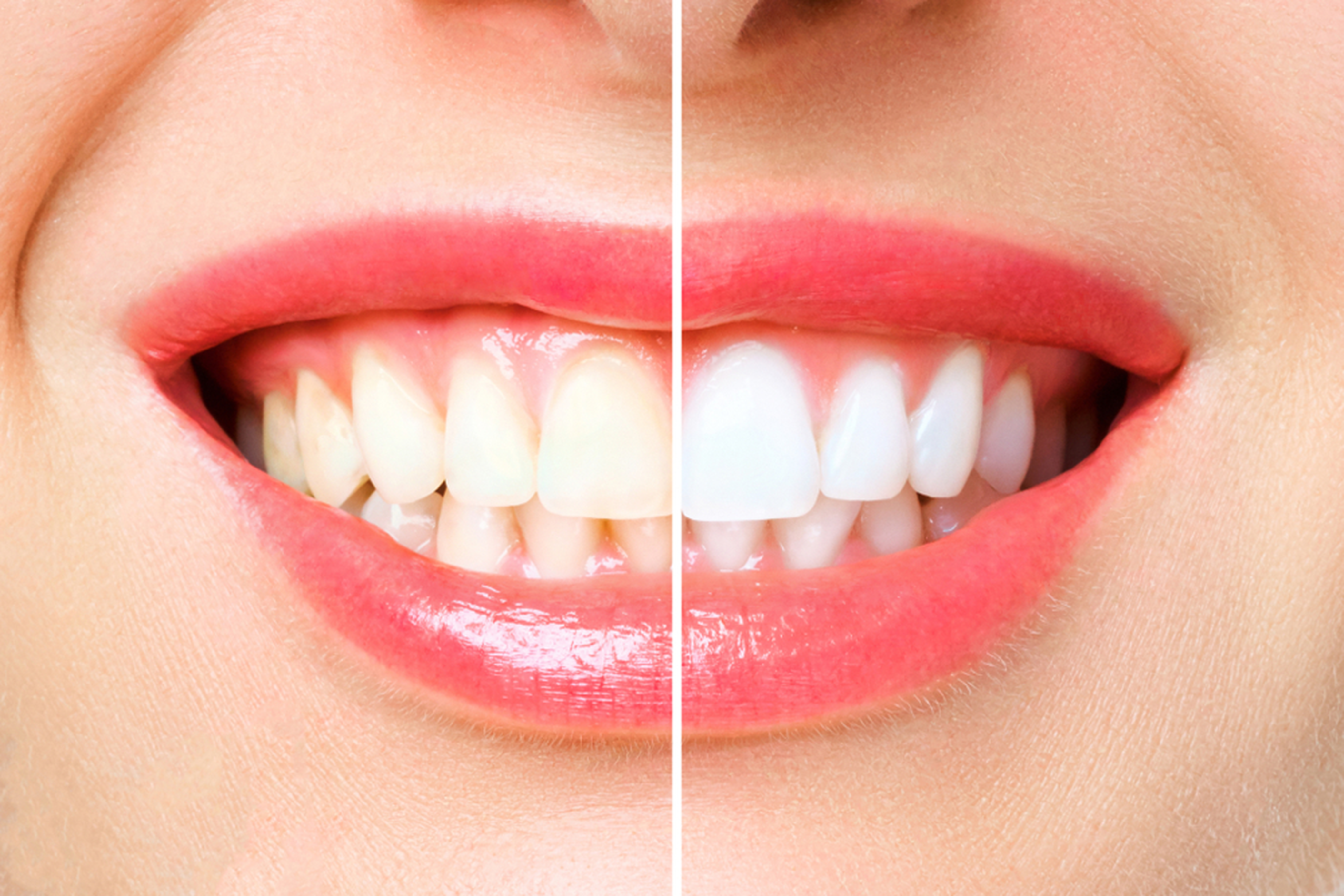 What to expect during teeth whitening treatment