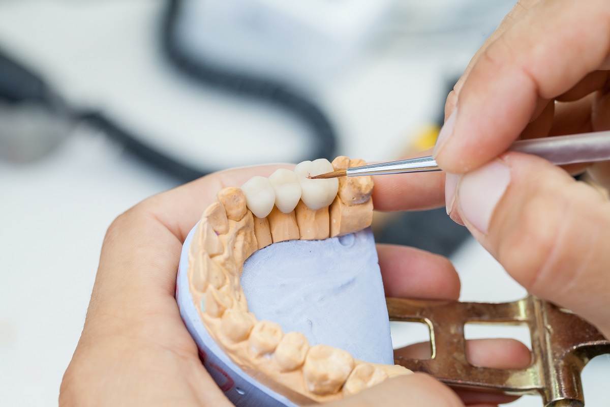 problems with dental bridges you should not ignore