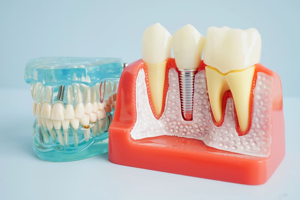root canal therapy in Sherwood Park