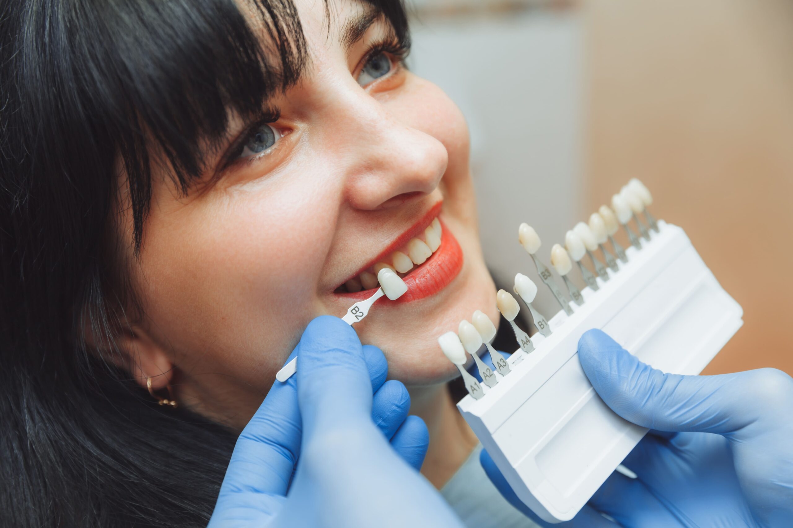 Dental Veneers
