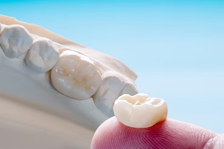 Sign your dental crown needs replacement