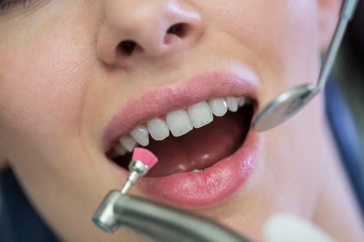 Why composite fillings are a popular choice today